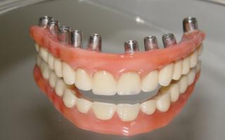 Implantes Dentrios e Prtese no Santa Efignia BH